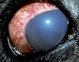 Acute glaucoma presents with scleral hypermia, cloudiness of the cornea, and pain