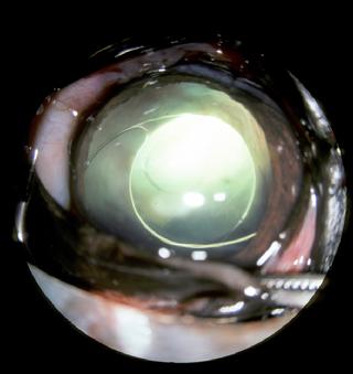 Once a cataract is removed, an Intraocular lens is put in place of the natural lens.